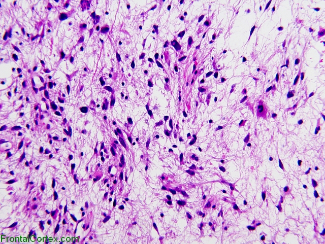 IIIrd ventricular glioma, H&E stain x200